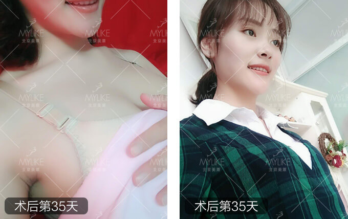 雨后薔薇戀綜合美胸整形+北京美萊胸部案例
