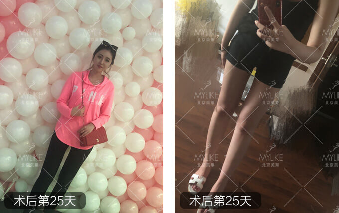 小岳岳呀大腿抽脂減肥+北京美萊吸脂瘦腿案例