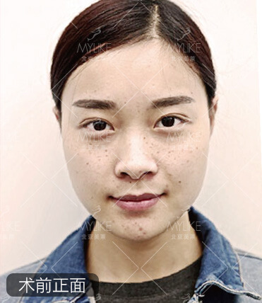 楊梅激光祛斑美膚+北京美萊皮秒祛斑案例