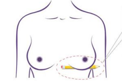 女性乳房下垂應該怎么辦