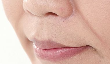 曲靖美萊醫院的自體脂肪填充鼻唇溝費用是多少呢