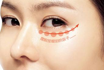 廣州做個祛眼袋手術需要多少時間才可以恢復呢