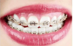 衡陽成年人牙齒矯正一般需要多長時間