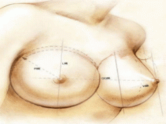 上海乳房下垂矯正有哪些方法