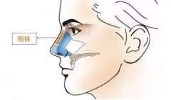 廣州膨體隆鼻修復術后應該注意哪些