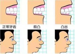 廣州矯正牙齒好處有幾個方面呢