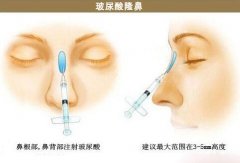 南京玻尿酸隆鼻多少錢一支？彌補美麗缺失