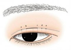 眼瞼外翻的出現有哪些原因