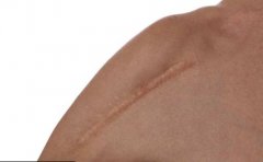 重慶做修復疤痕一般需要多少錢