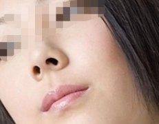 矯正鼻孔大的手術會留疤嗎？