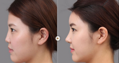 自體材料鼻部整形效果能維持多久？