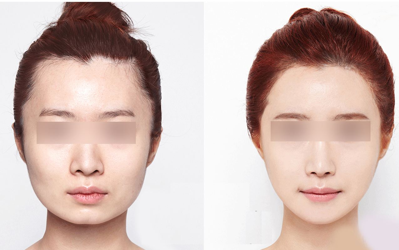 瘦臉的副作用是什么？