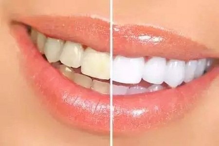 美白牙齒整形