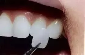 牙齒美白