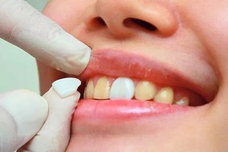 牙齒發黃怎么辦？還有救嗎？