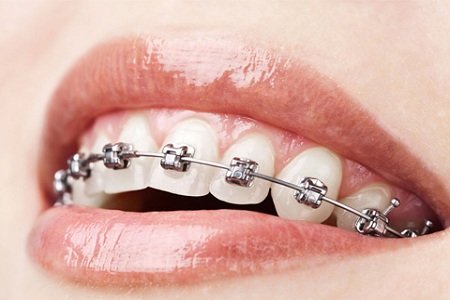 醫美白皮書：被透明牙套拯救的鋼牙妹們
