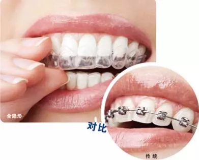 醫美白皮書：被透明牙套拯救的鋼牙妹們