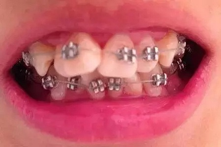 這種牙齒矯正方式，96%的人都會選擇！