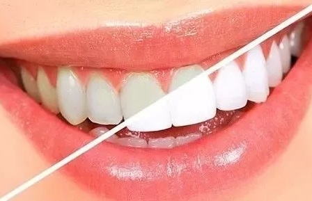 牙齒也能敷“面膜”？這款明星美牙秘籍了解下