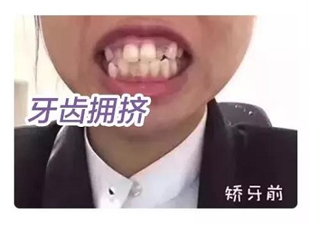 牙齒矯正