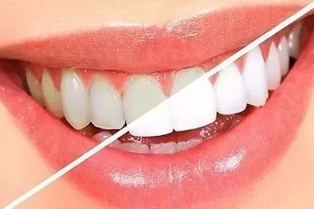 牙齒矯正的好處有哪些