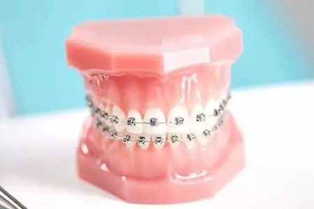 牙齒矯正費用為什么會這么貴