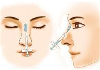 玻尿酸隆鼻可以維持多久