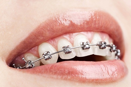 牙齒出現哪些情況需要進行矯正