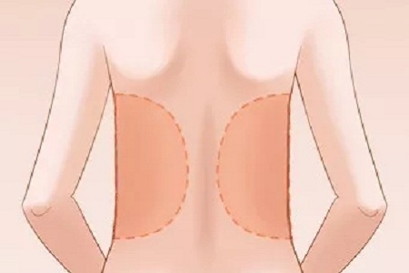 成都做腰部吸脂手術會有疤痕嗎