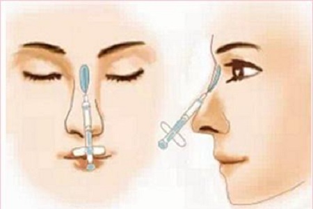 石家莊假體隆鼻術后注意哪些方面