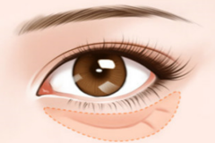 鄭州美萊祛眼袋手術注意事項有哪些？