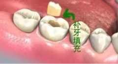 鄭州美萊整形怎么治療牙齒缺損