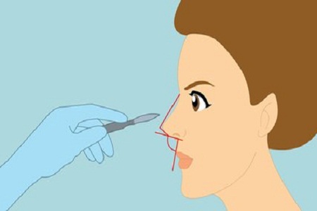 長沙美萊注射隆鼻一般能保持多久