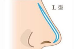 在廣州做假體隆鼻手術大概價格多少