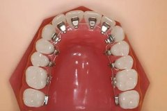 舌側牙齒矯正的費用是多少，矯正后會反彈嗎