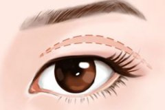 腫眼泡可以通過手術去掉嗎，眼部抽脂多少錢一次