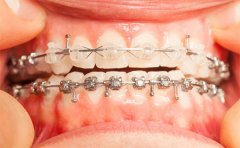 矯正牙齒用金屬的好還是隱形的好，2023牙齒矯正價格表