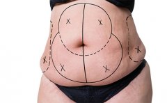 腰腹吸脂對身體有害嗎，腰腹環吸抽脂需要多久恢復期