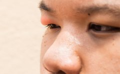 天生腫眼泡抽脂會反彈嗎，南京、杭州、上海眼皮抽脂費用表