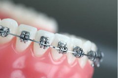 金屬自鎖托槽牙齒矯正價格，多久能看見效果